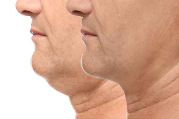 HIFU - Breakthrough in Anti - ageing 2 hifu results Dover