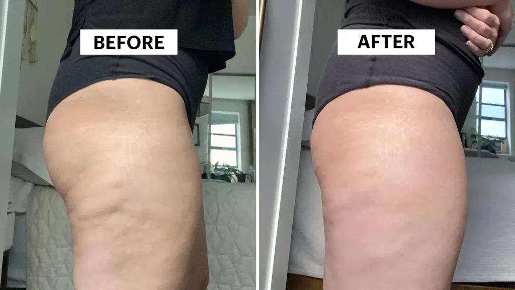 Sculpting Your Bum: Can Toning Exercises Really Reduce Cellulite? 1 Do Toning Exercise Dover Really Tackle Cellulite?