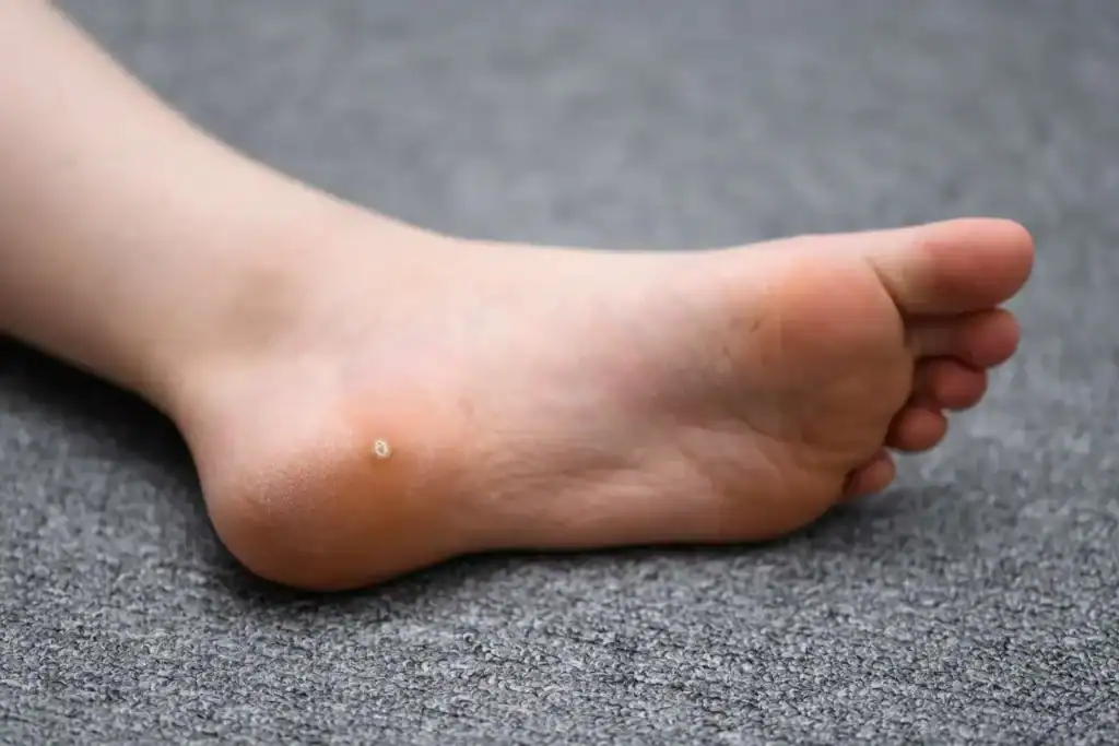 Cryotherapy For Warts And Also Verrucas 2 Image of verruca on the bottom of the foot that able to be treated with Cryotherapy Dover