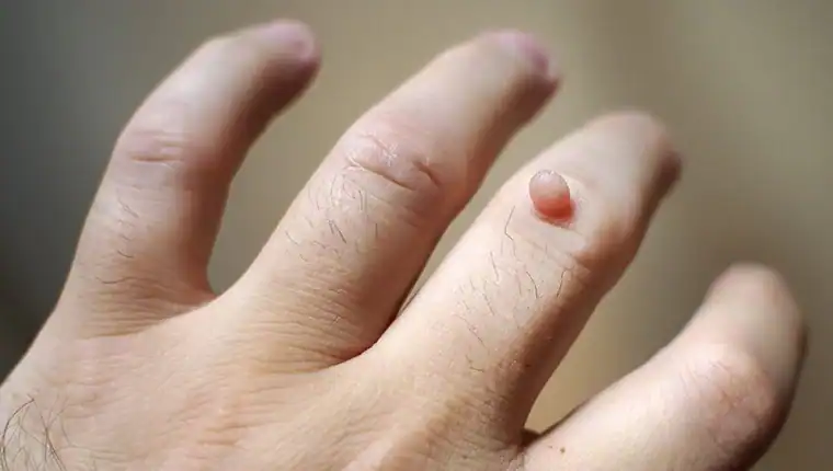 Cryotherapy For Warts And Also Verrucas 1 Image of blemish that Cryotherapy Dover can remove with Lipo 360.