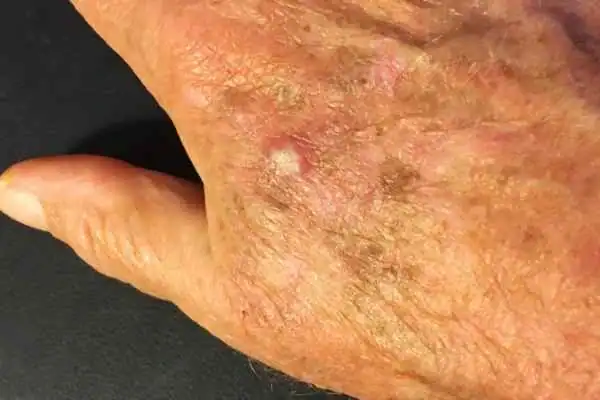 CryoPen for Actinic Keratoses 1 Image of Actinic keratoses Dover on a person hand