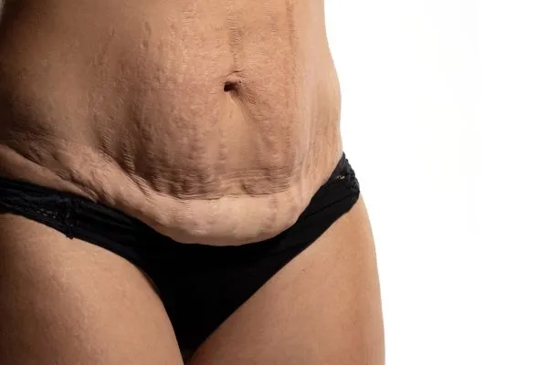 The Science of Skin Tightening 1 The science behind skin tightening Dover picture of a woman's sagging skin on the stomach